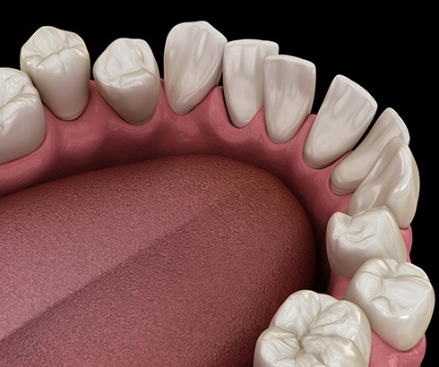 Illustration of gapped teeth