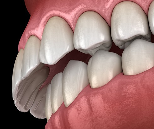 Illustration of overbite