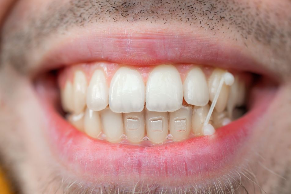 A man with Invisalign attachments on his teeth.